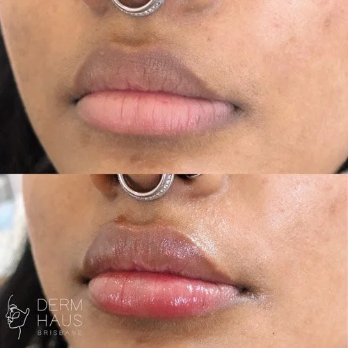 Brisbane's Top Rated Lip Filler Clinic Derm Haus Brisbane