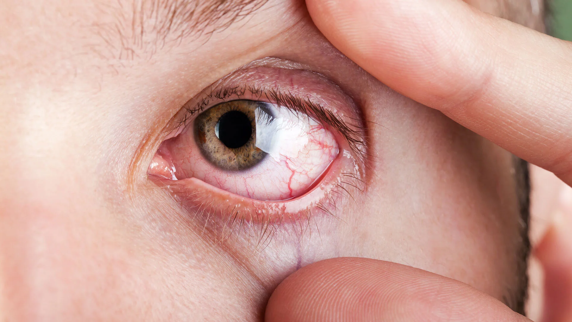World Allergy Week — Eye Allergy/Allergic Conjunctivitis Awareness — Eye doctors eyeglasses