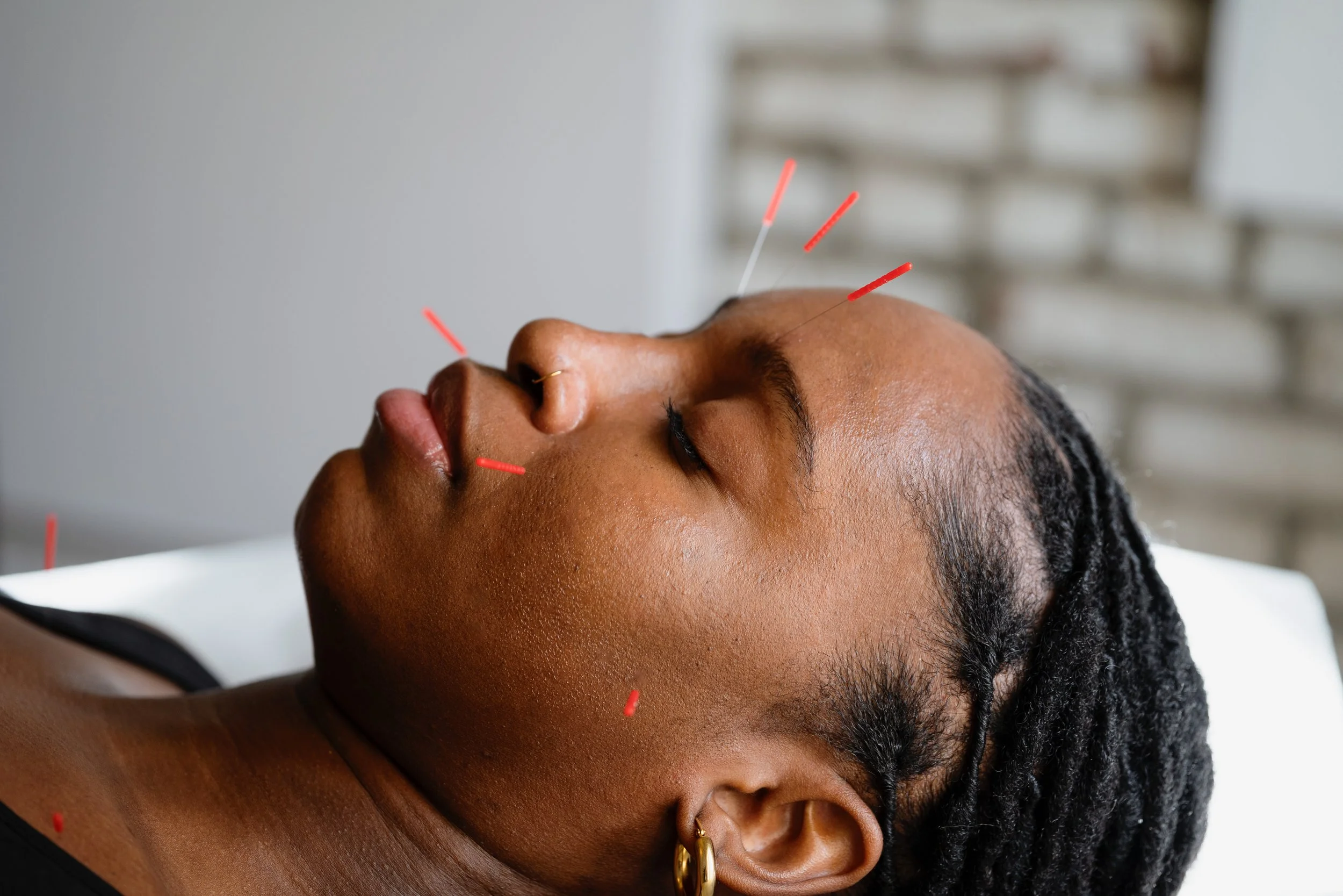 Understanding Endometriosis and How Acupuncture Can Help
