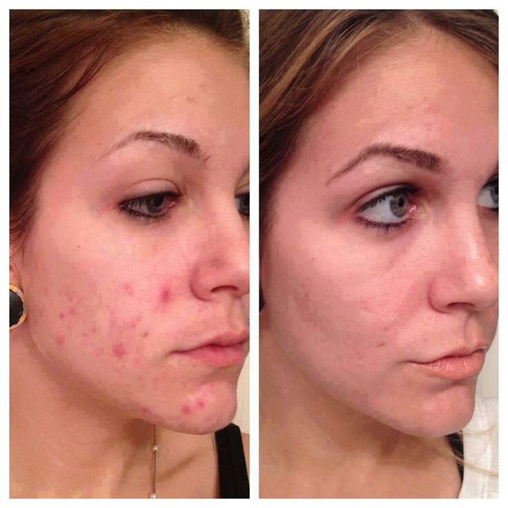 unblemish b4:after.jpg