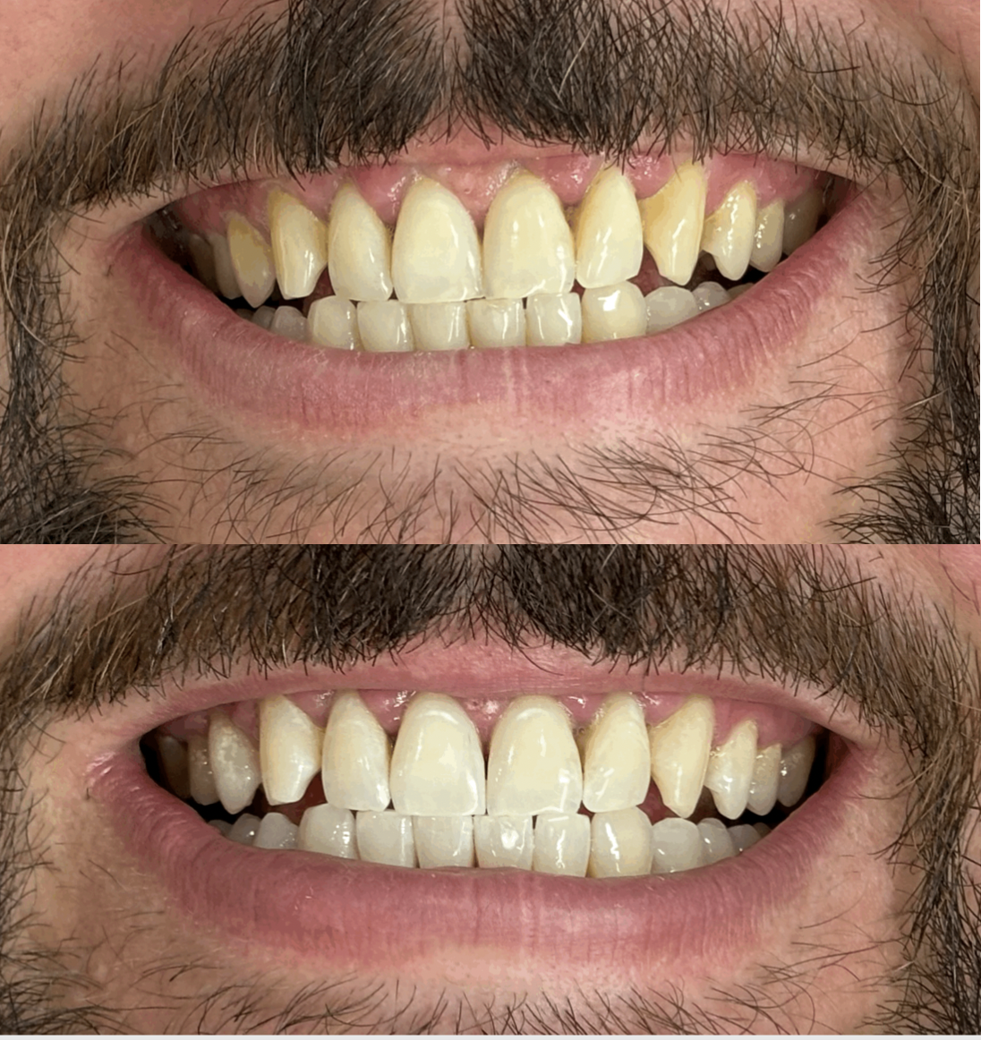 Before and after photos of a man's teeth, showing whitening results. Teeth Whitening Christchurch before and after