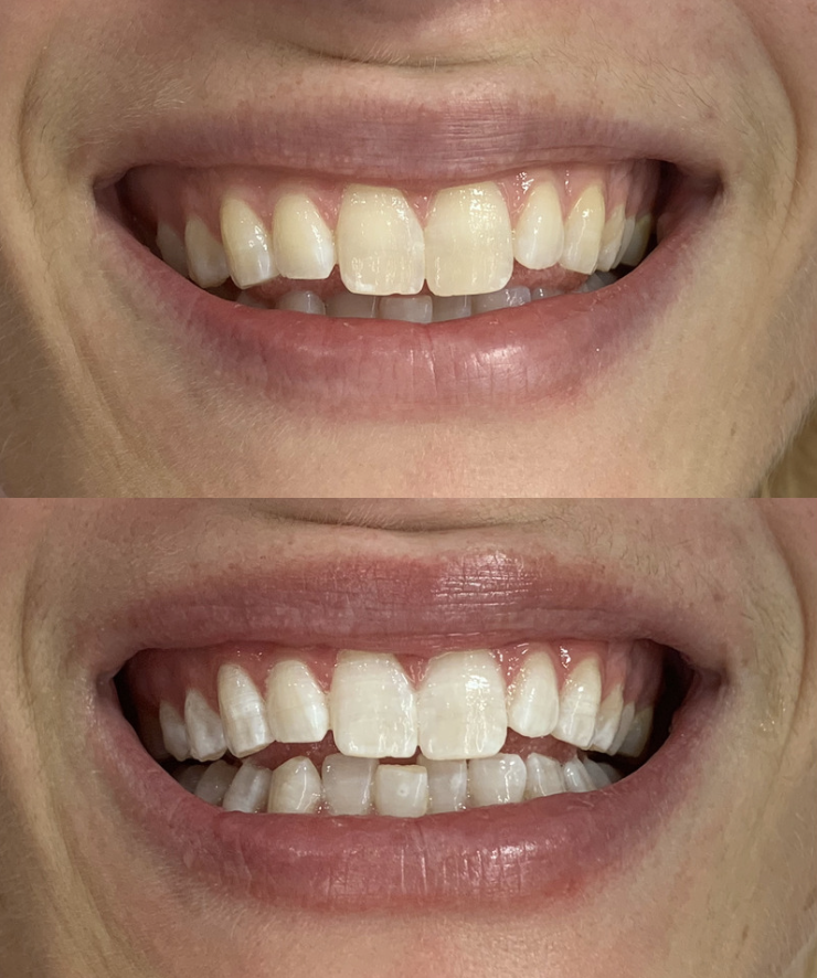 Teeth Whitening Christchurch before and after