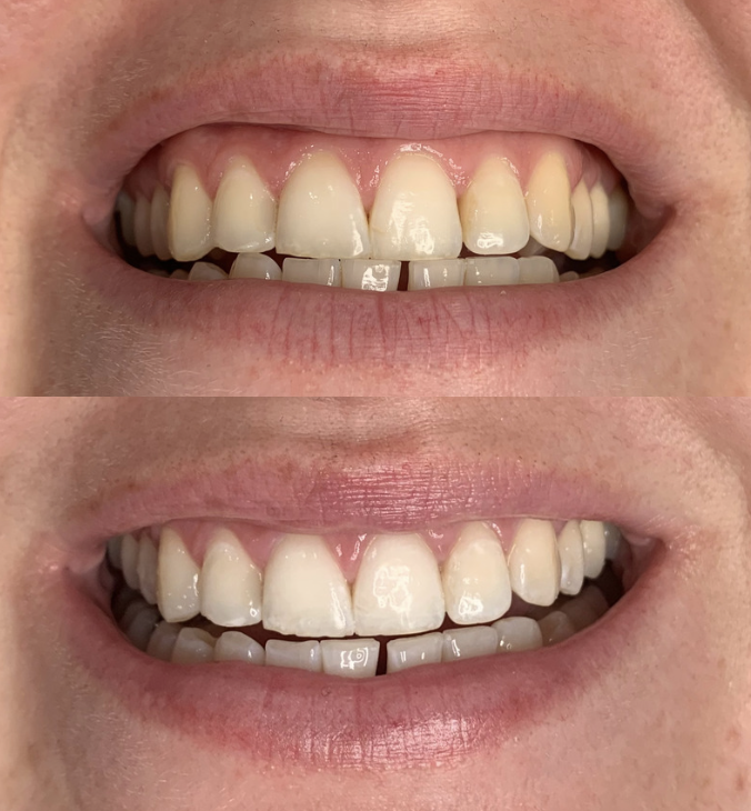 Teeth Whitening Christchurch before and after