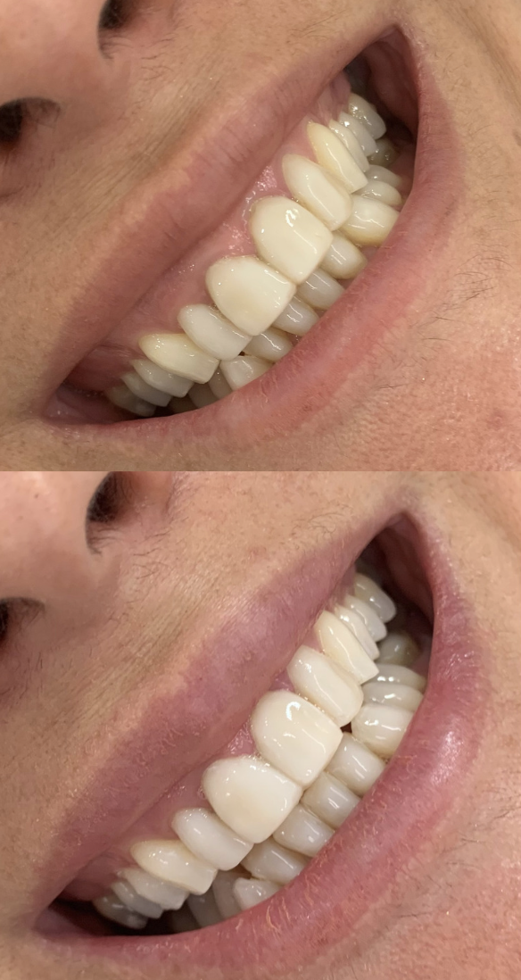 Teeth Whitening Christchurch before and after