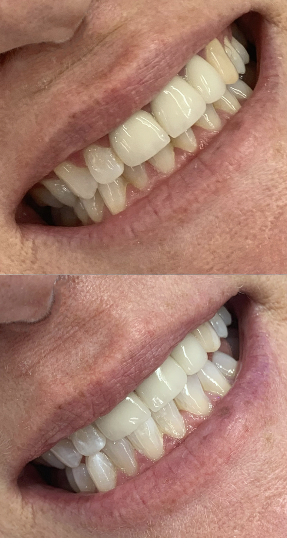 Teeth Whitening Christchurch before and after
