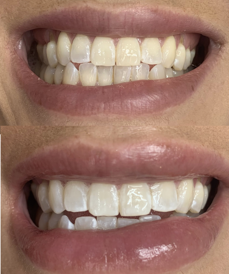 Teeth Whitening Christchurch before and after
