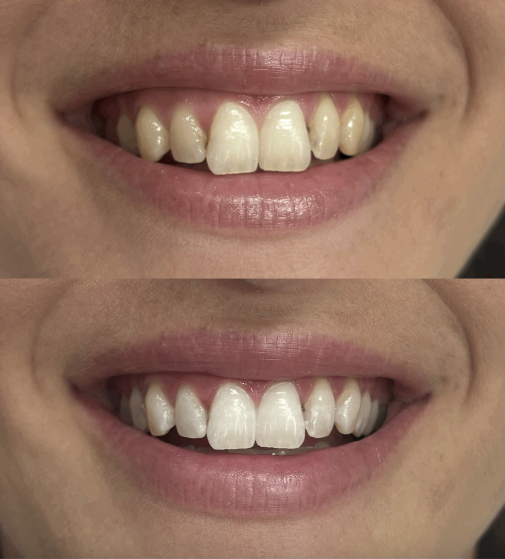 Teeth Whitening Christchurch before and after