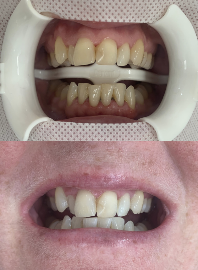 Teeth Whitening Christchurch before and after