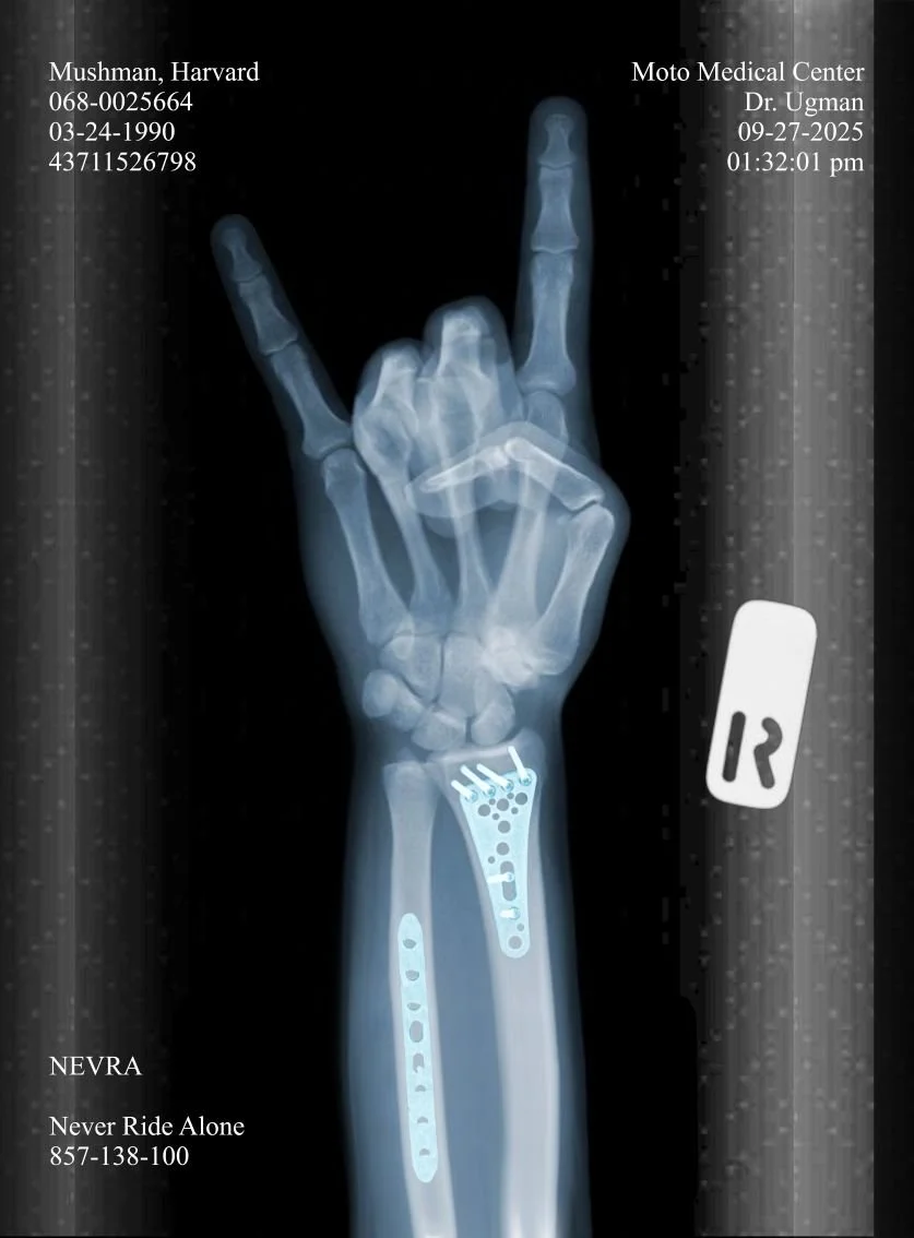 X-ray of a surgically repaired wrist with metal plates and screws, showing the hand and forearm with the hand making a "rock on" gesture