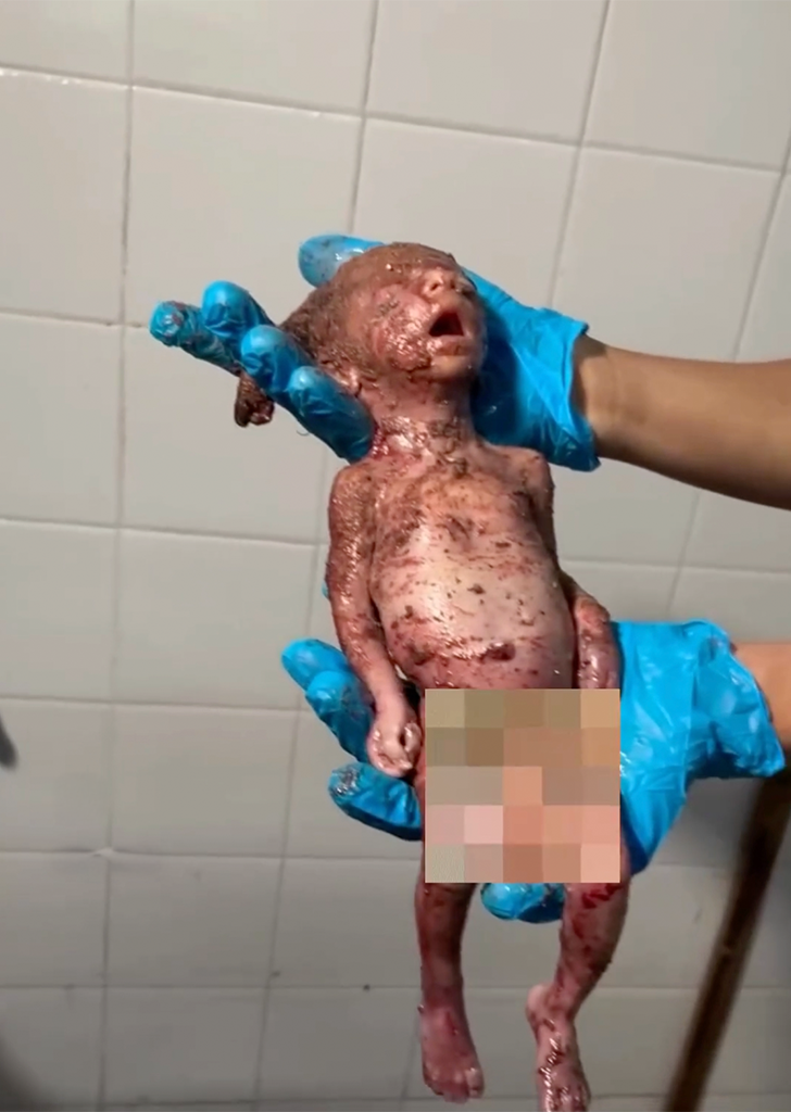   An unborn Palestinian baby, delivered lifeless from the womb after Israeli bombing, is held by medical staff in Gaza—evidence of how even the unborn are not spared by the occupation’s assault.  