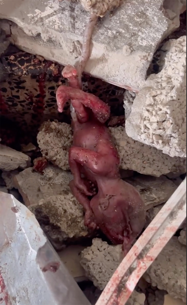   The body of a fetus torn from its mother’s womb lies in the rubble after an Israeli airstrike in Gaza, the umbilical cord still attached.  