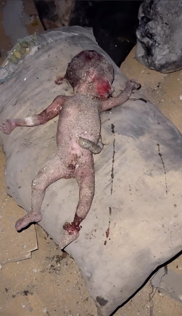   A premature Palestinian infant, killed inside the womb by Israeli bombardment, recovered from beneath the ruins—its body coated in dust and blood.    