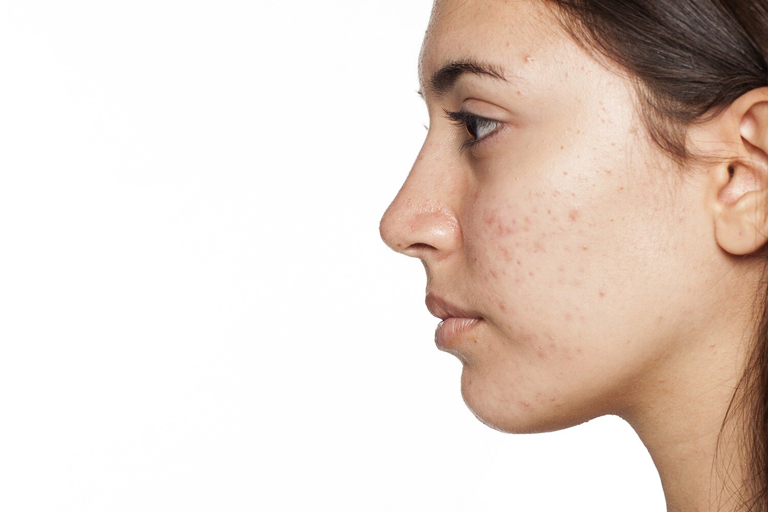 What Causes Post-Pill Acne? — The Clinic Skin Health