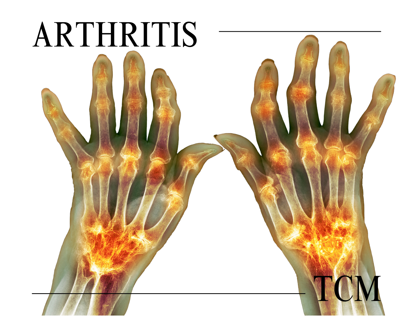 arthritis newsletter.png