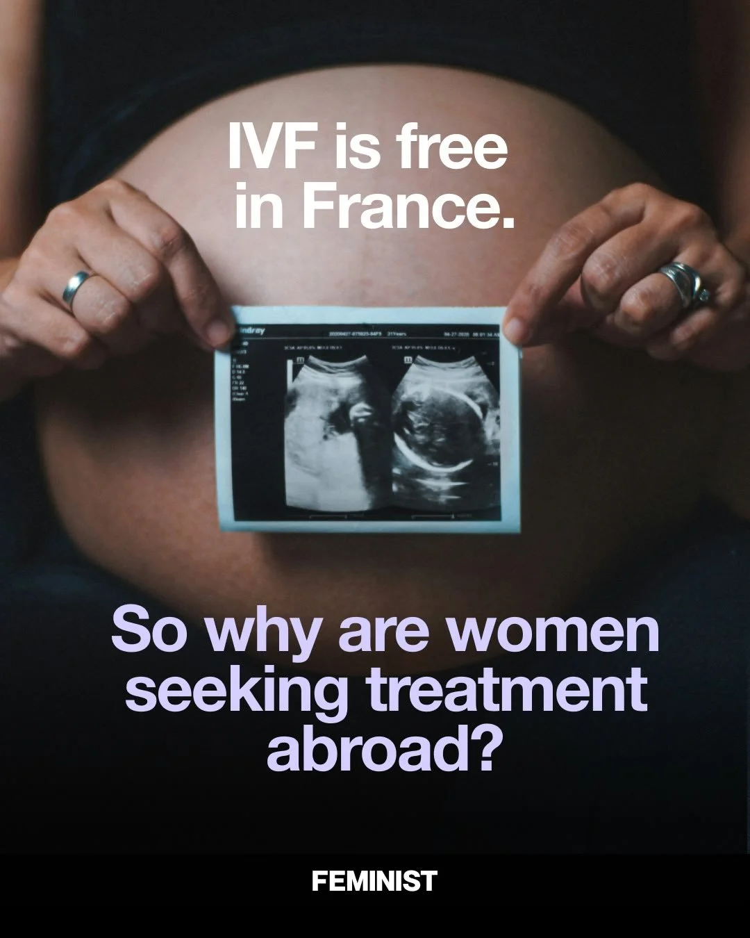 Since IVF was legalized and publicly funded for single women and same-sex couples in 2021, access has expanded in theory. In practice, many lesbian couples and single women encounter long waiting lists, donor shortages, and intrusive questions that s