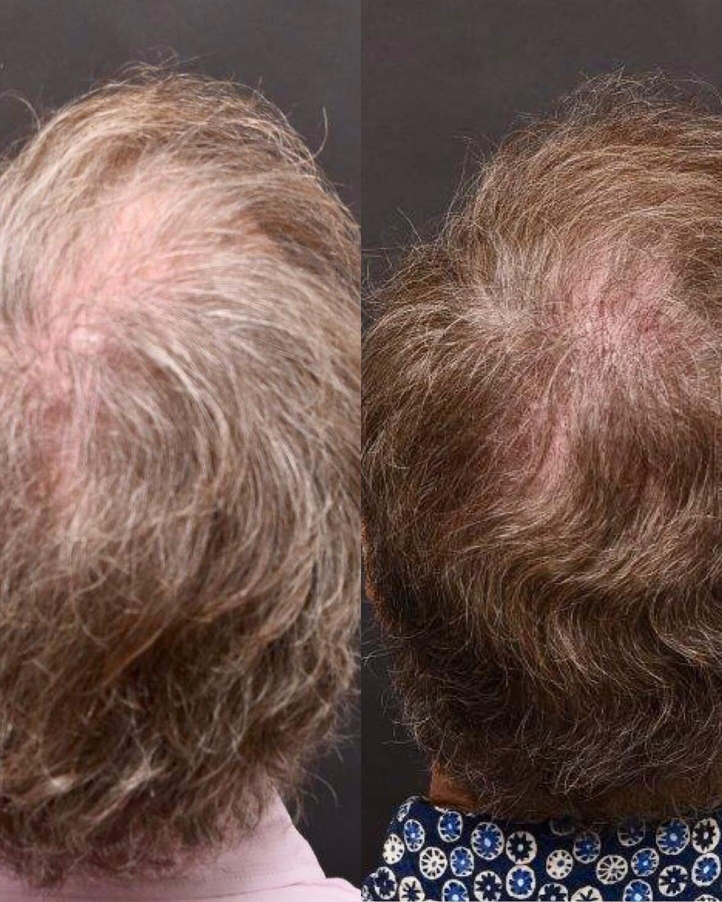 Check out these phenomenal results using the regenerative technology of exosomes for hair rejuvenation! This is his real hair y&rsquo;all!! 

Exosomes are regenerative nanotechnology with 100x more growth factor than prp! 

No blood draw needed! Easy