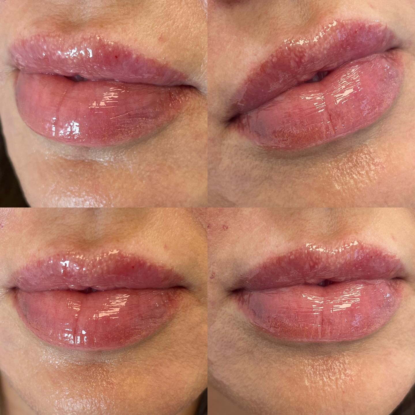 #treatmentthursday 

How about these lips?!! &hearts;️💋😘

This gorgeous patient has a naturally full bottom lip! These pics were taken immediately after injecting .5ml of Refyne to give hydration only! 

💉I always recommend @revisionskincare Youth