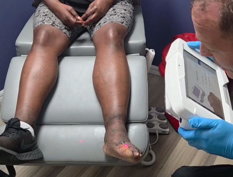 taking image of patient foot with snapshotNIR, big toe on patient is amputated and patient has dark skin