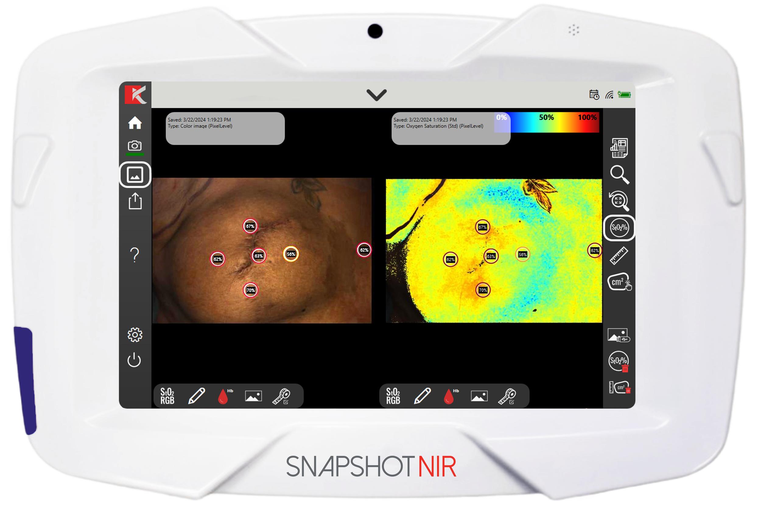 SnapshotNIR Used to Predict Skin Flap Necrosis Intra-Operatively in Oncologic Resection Reconstruction