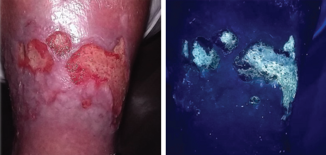 Improving Debridement Precision and Wound Bed Preparation Using SnapshotGLO