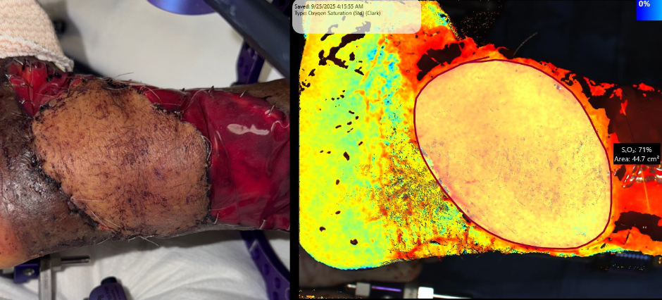 SnapshotNIR-Guided Flap Viability Monitoring in Reverse Sural Artery Fasciocutaneous Flap Surgery