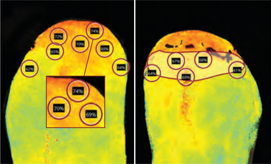 Transverse Tibial Bone Transport for a Non-Healing TransmetatarsalAmputation and Peripheral Arterial Disease