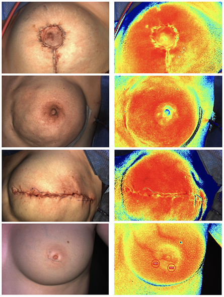 Appearance of PSPG 18 days following bilateral DIEP flap breast