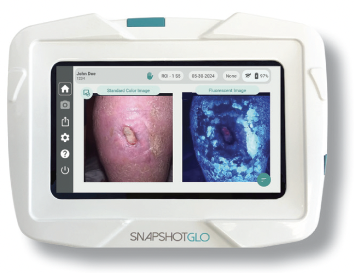 SnapshotGLO, a bacterial autofluorescence medical imaging device — Kent ...