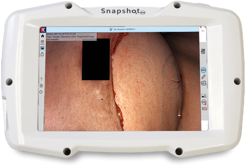 Surgical Flap-07