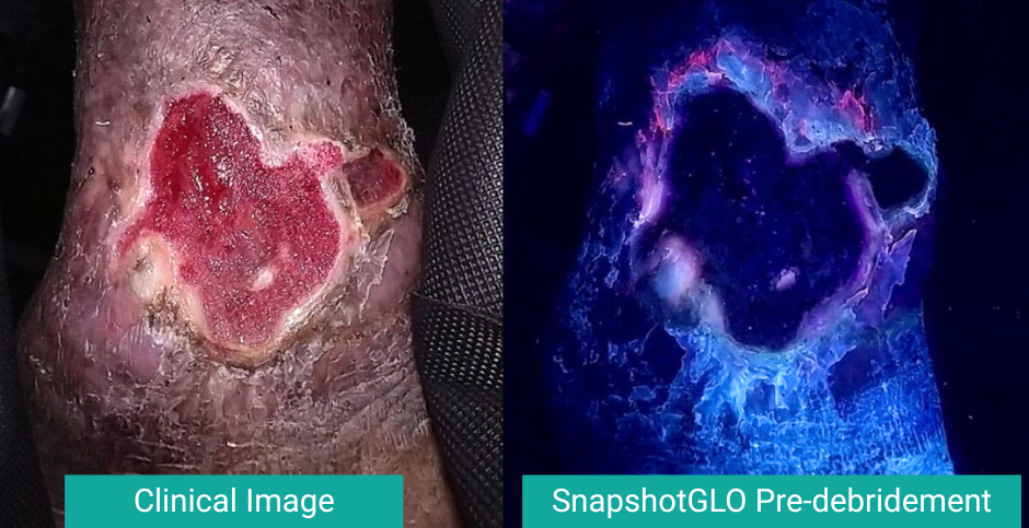 niezgoda sexton grenada pre debridement image