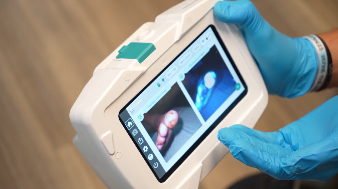 close up image of SnapshotGLO with a patient's toe on the screen and gloved hands holding the device