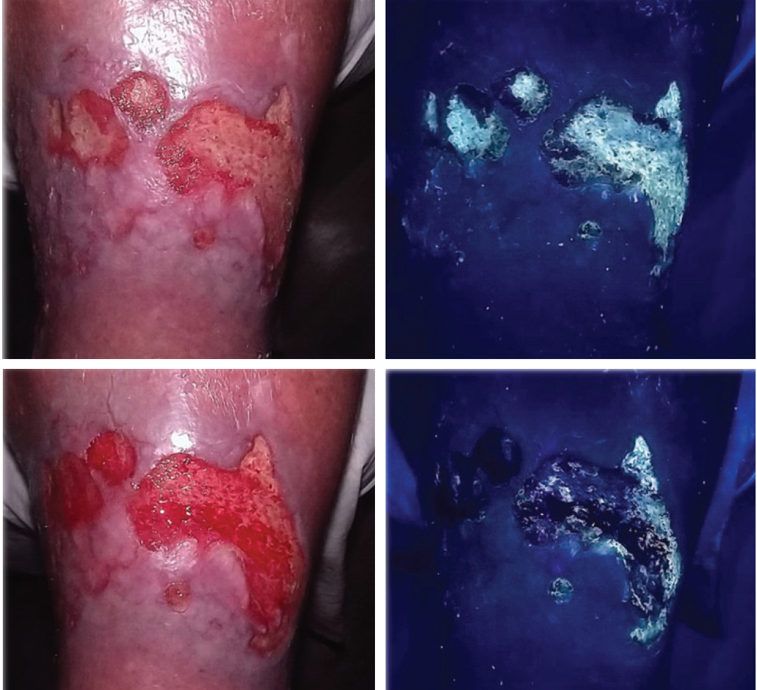 chronic leg ulcers sexton glo case 2 pre and post debridement.png