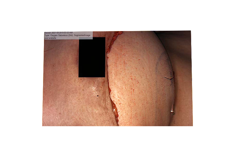 Surgical Flap-06