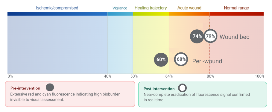 graph depicting pre intervention and post intervention StO2 numbers in the wound bed and peri wound increasing.