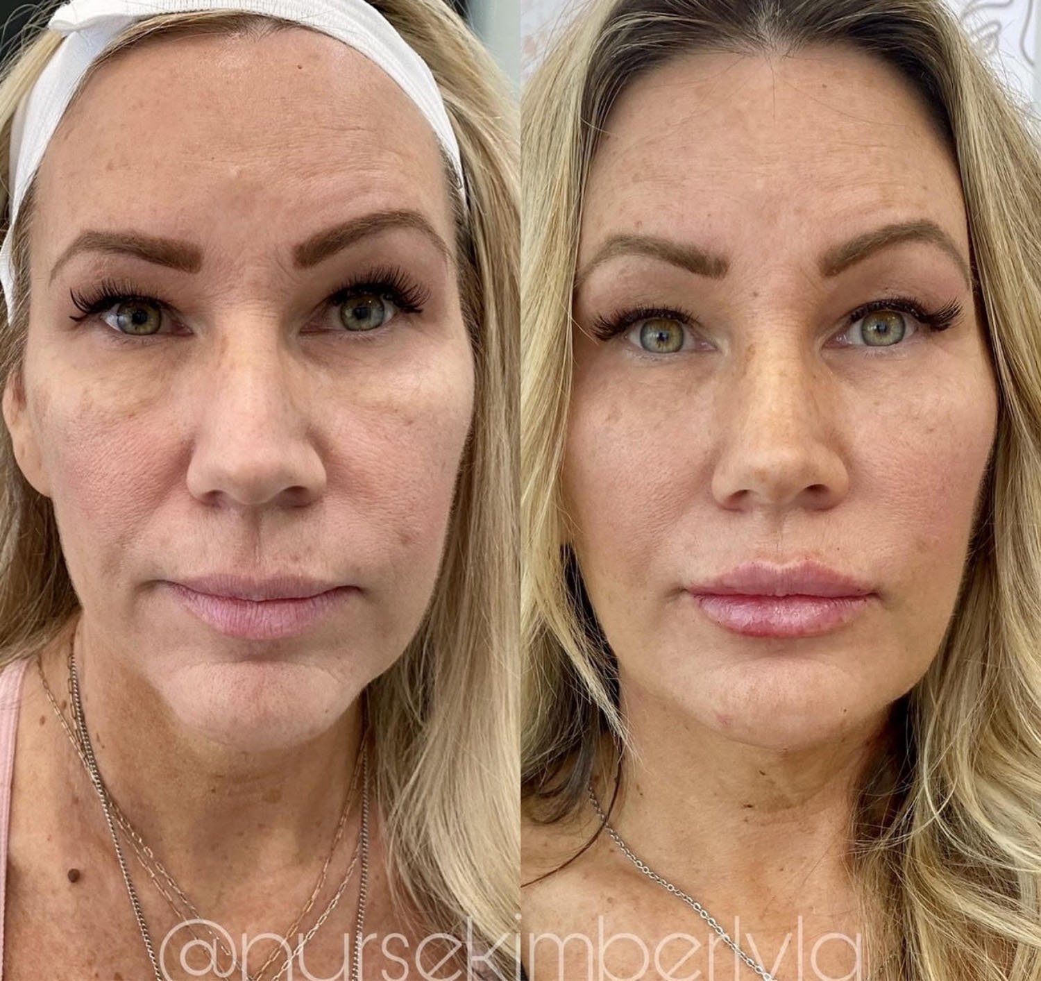 Kimberly botox injections before and after.jpg