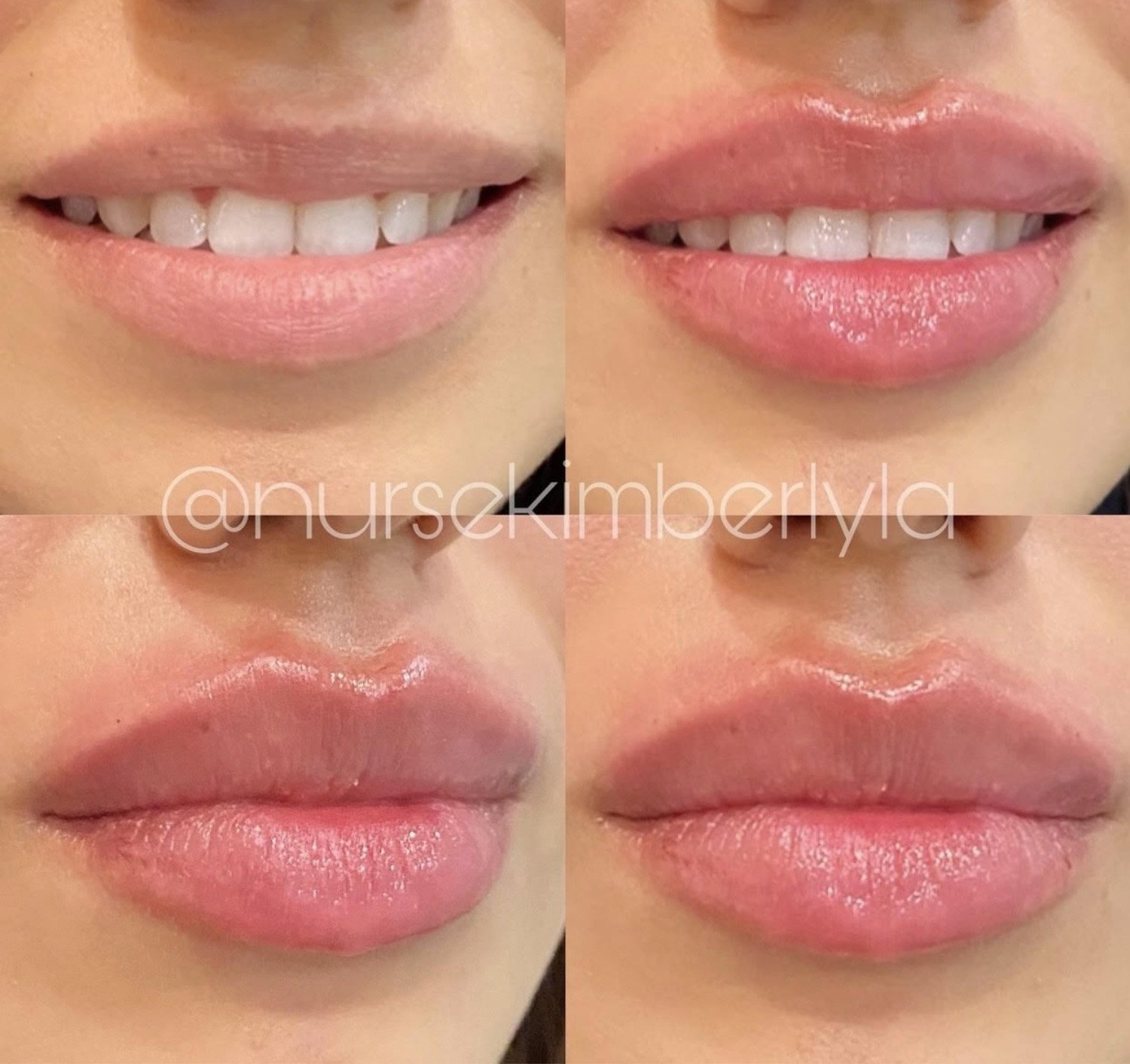 Kimberly lip botox before and after.jpg