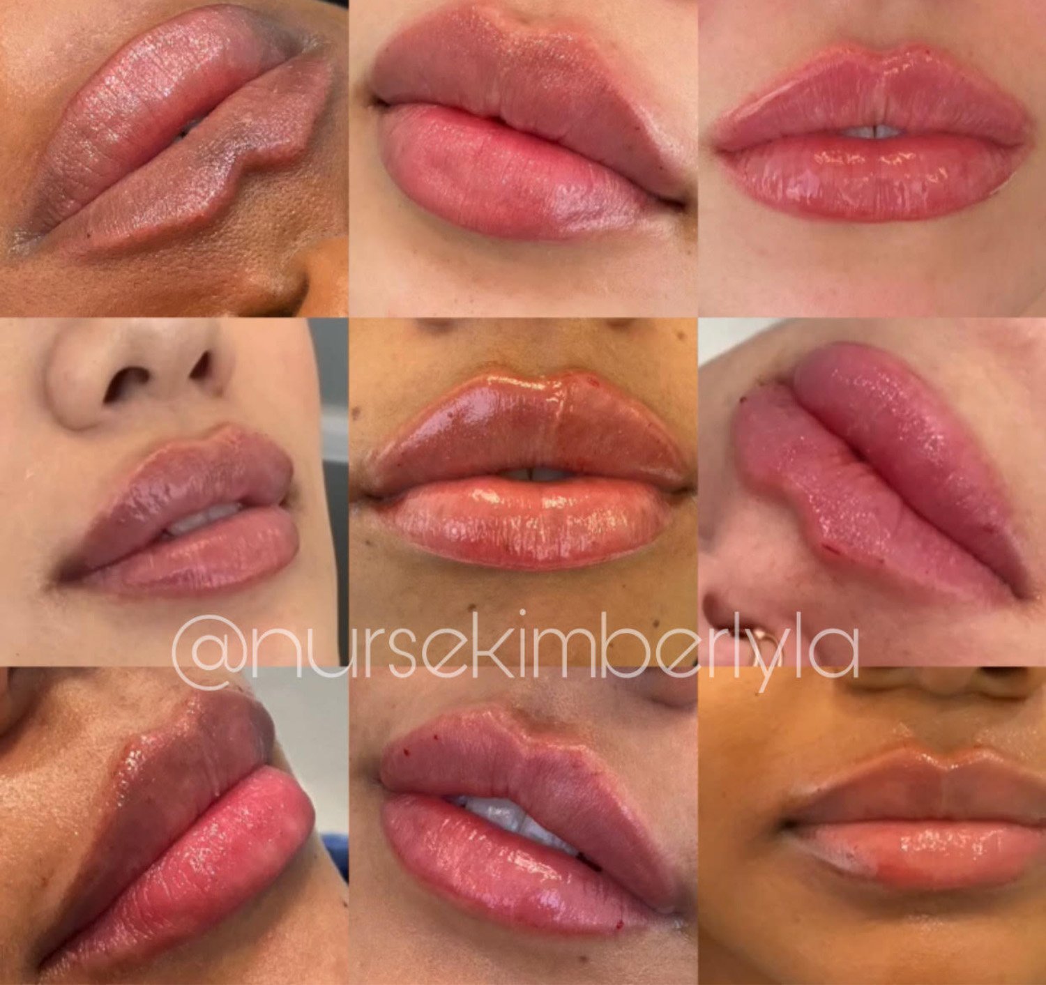Kimberly cosmetic lip before and after.jpg