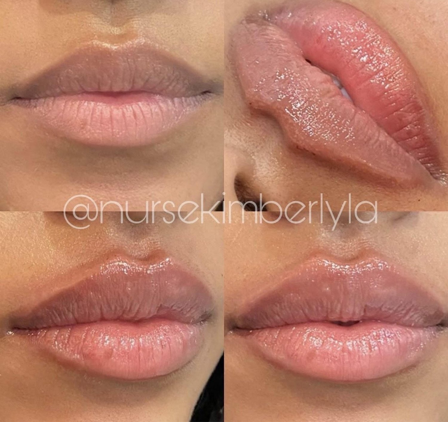 Kimberly cosmetic lip botox injection before and after.jpg