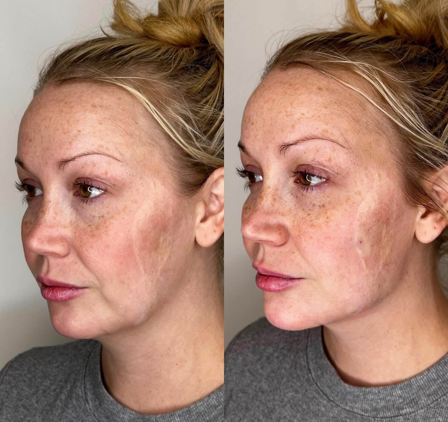 Amy Davis refined jawline before and after results.jpg