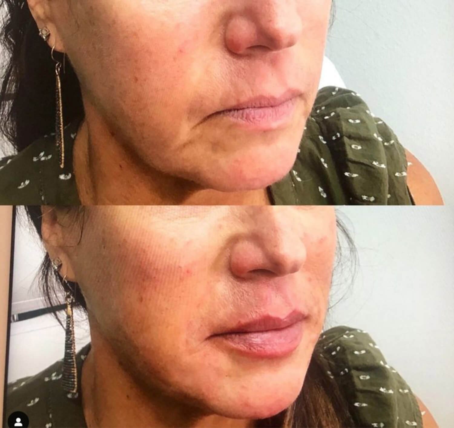 Amy Davis natural looking lip enhancement botox filler befor and after.jpg