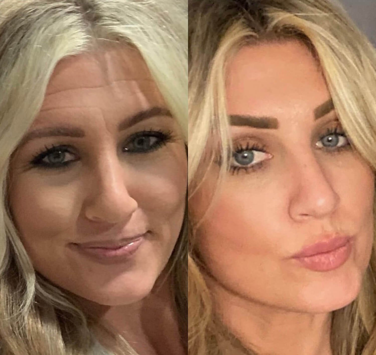 Amy Davis botox for laugh lines before and after.jpg