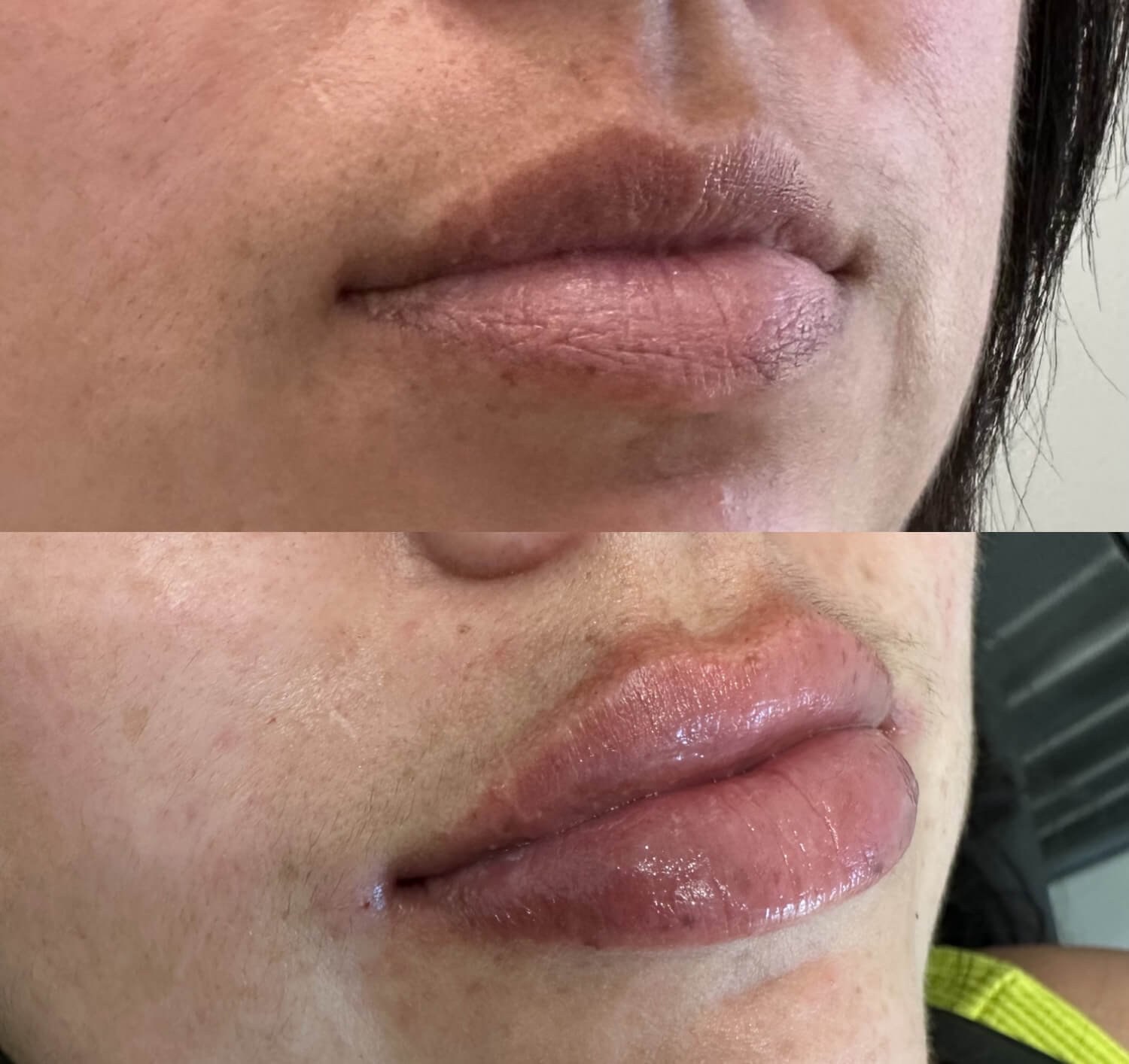 Ashley Farnham botox lip flip before and after.jpg