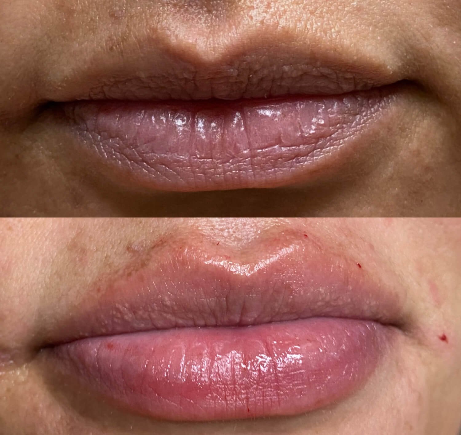 Ashley Farnham lip filler botox before and after.jpg