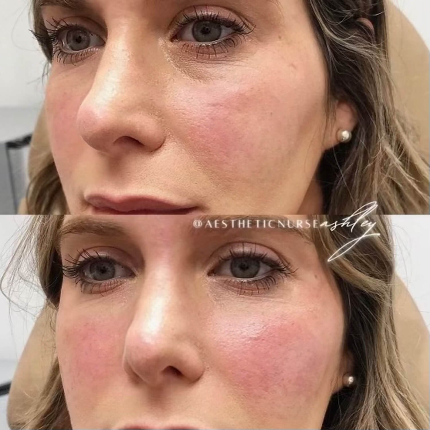 Ashley Reader botox under eyes before and after results.jpg