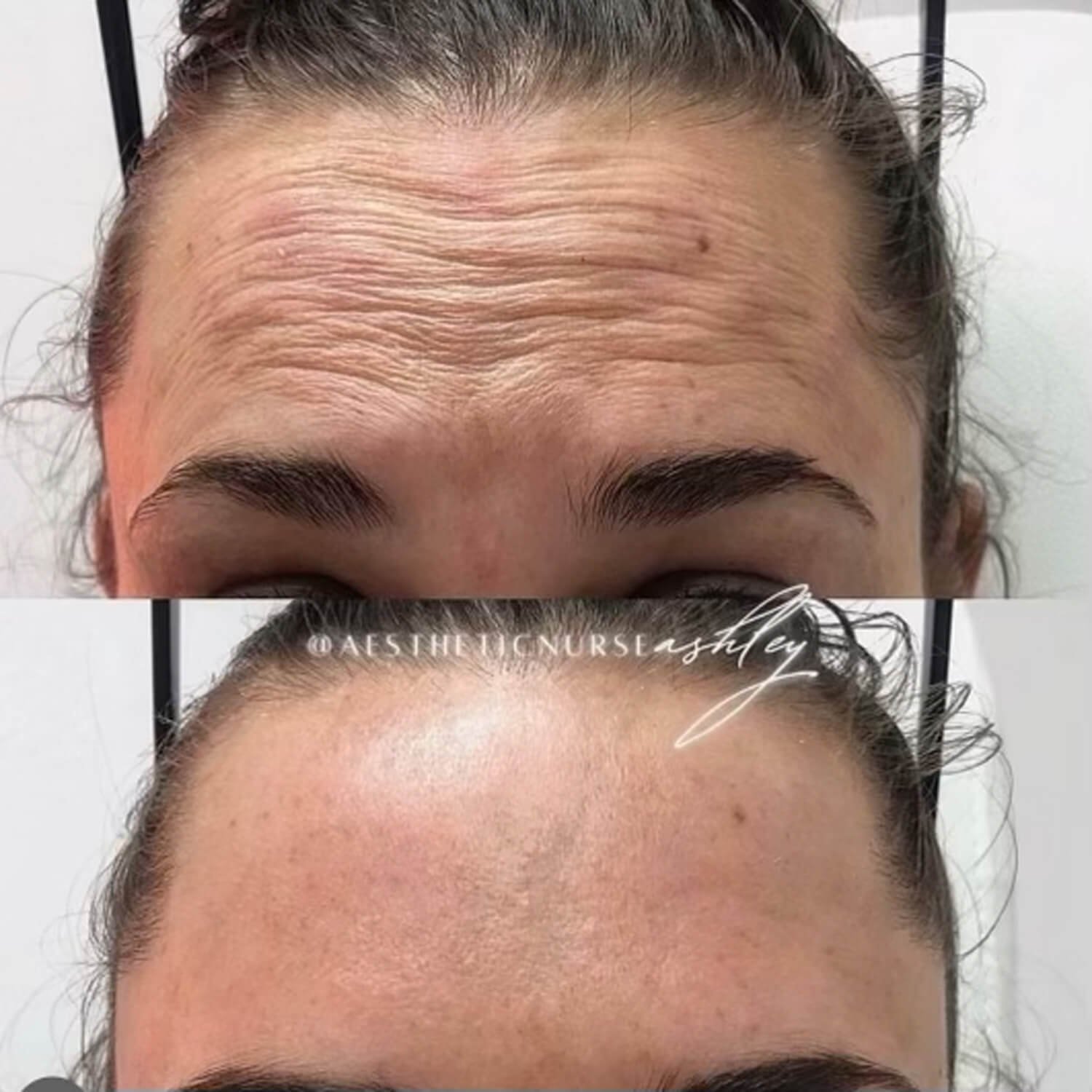 Ashley Reader smooth forehead wrinkles before and after.jpg