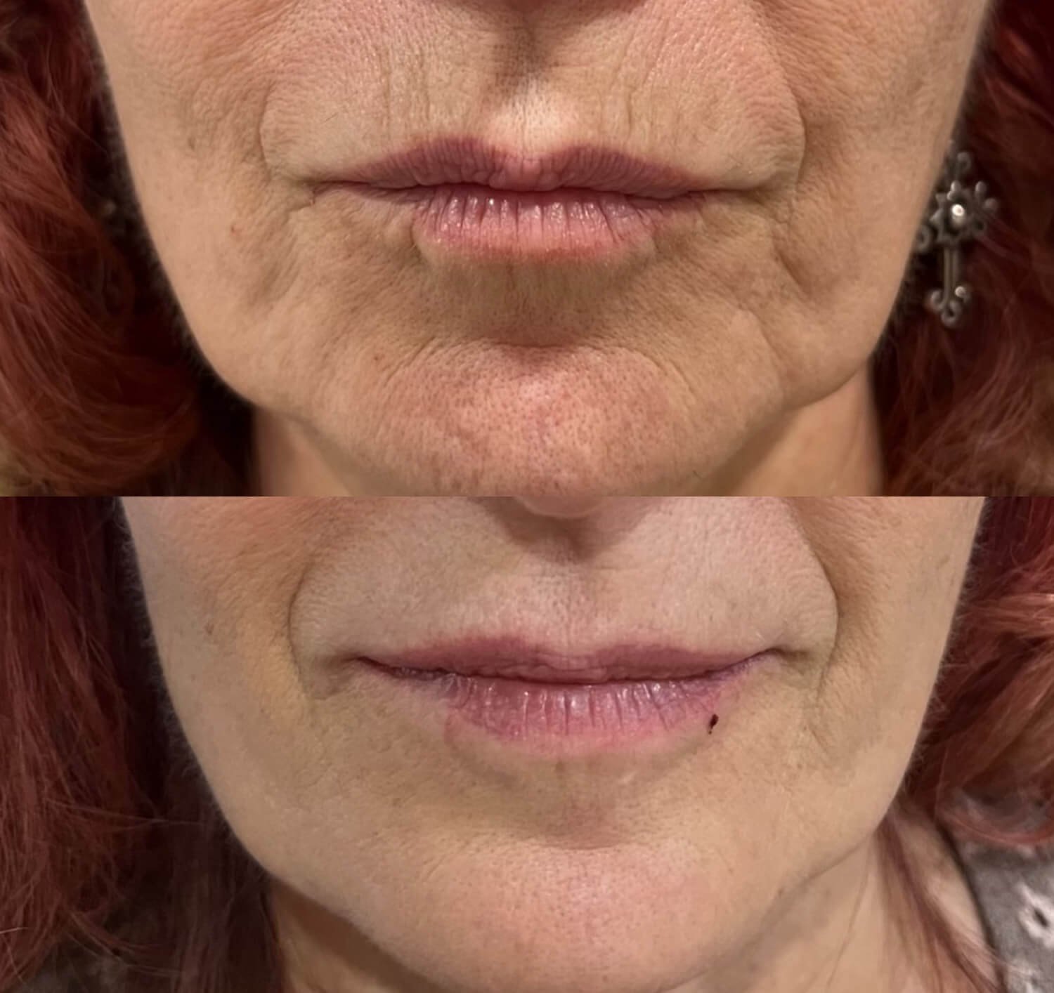 Christine Yanikian botox for laugh lines before and after.jpg