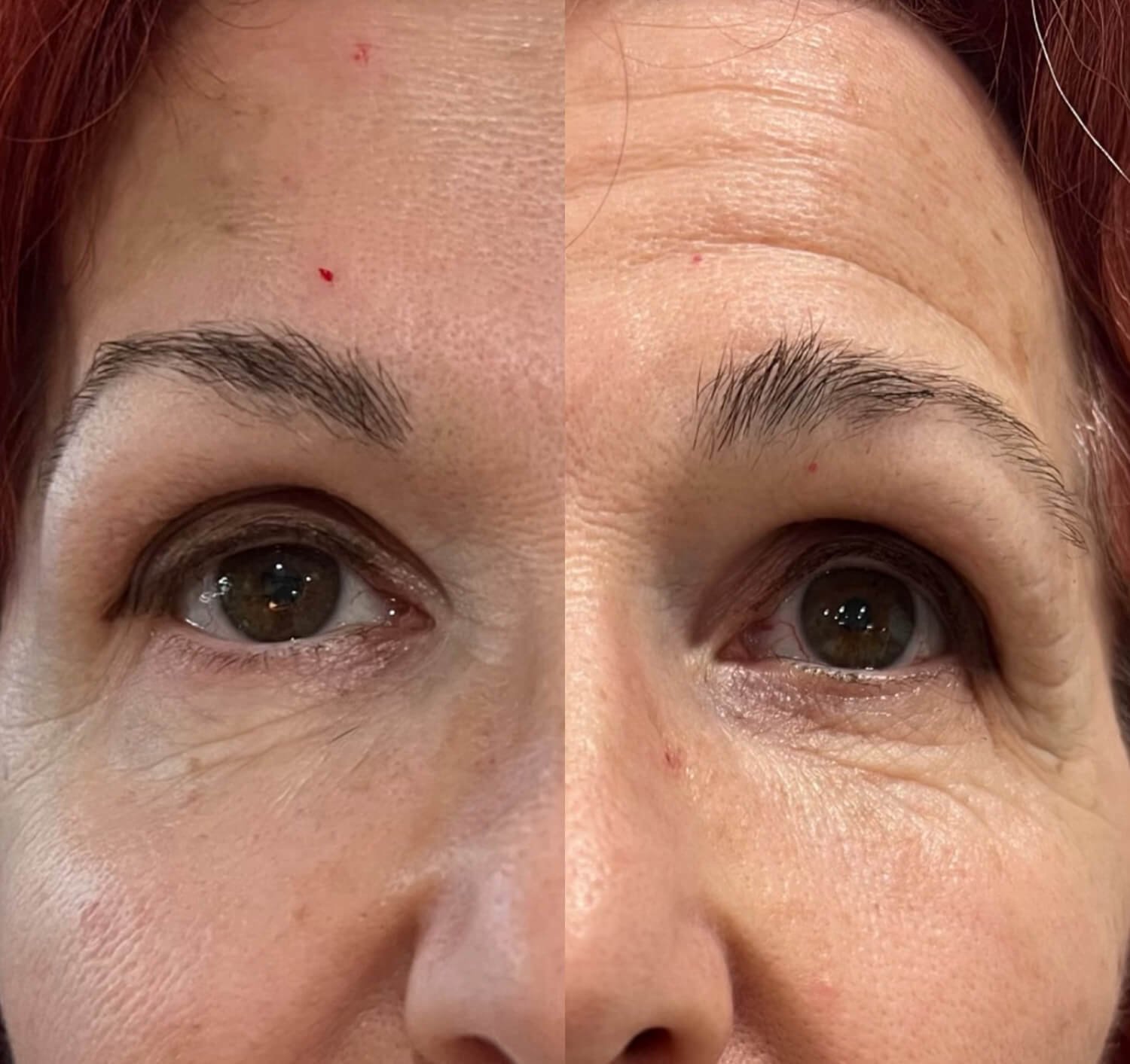 Christine Yanikian smooth forehead wrinkles botox before and after.jpg