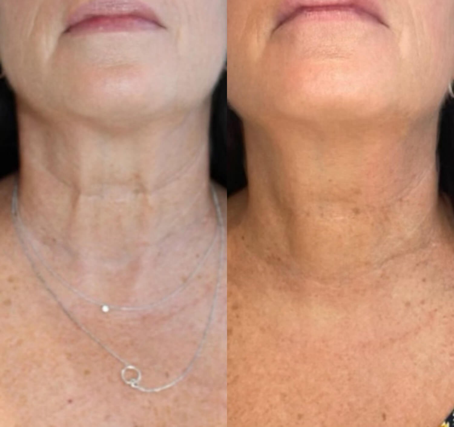 Christine Yanikian smooth neck wrinkles before and after.jpg