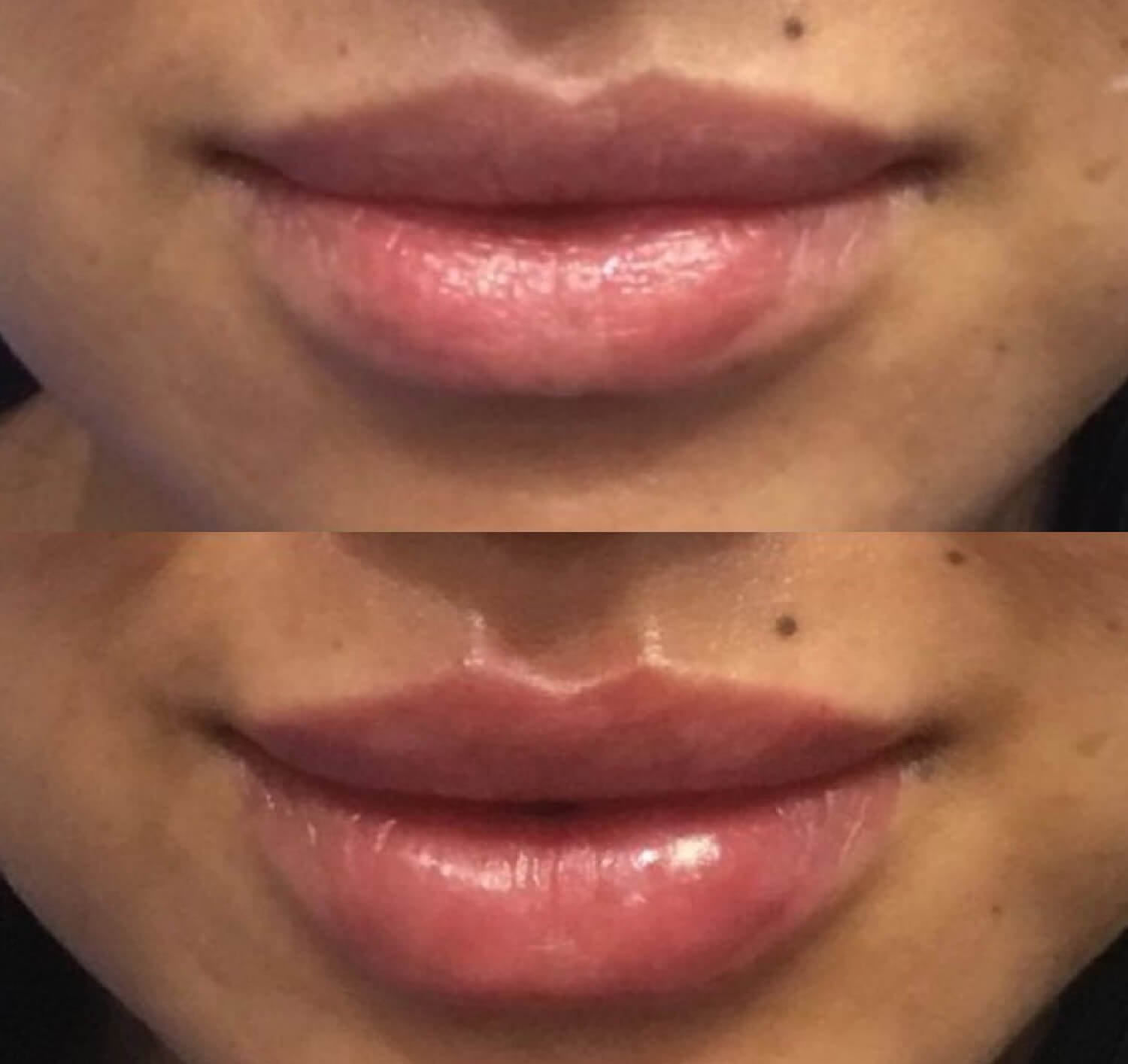 Danielle Bruyn natural looking lip enhancement botox before and after.jpg