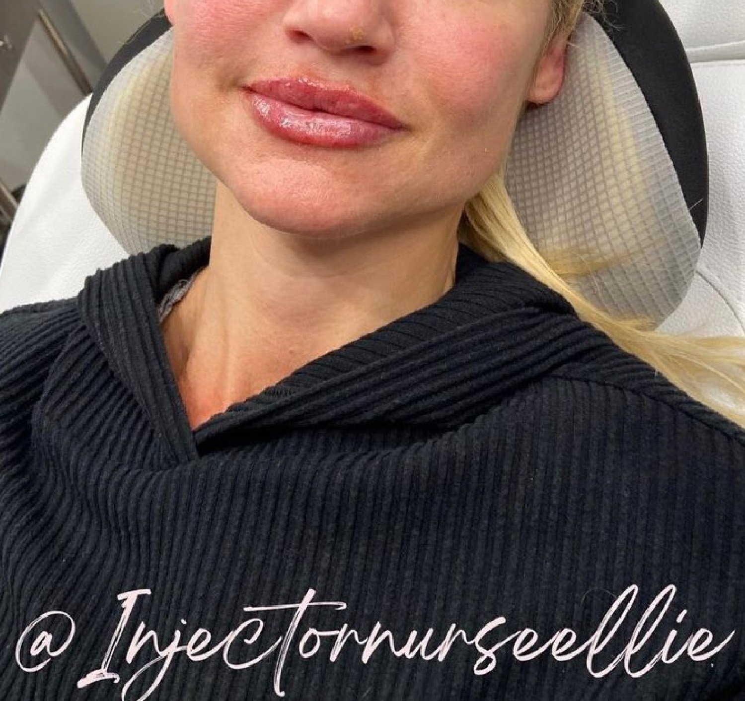 Ellie Lambert botox lips.jpg